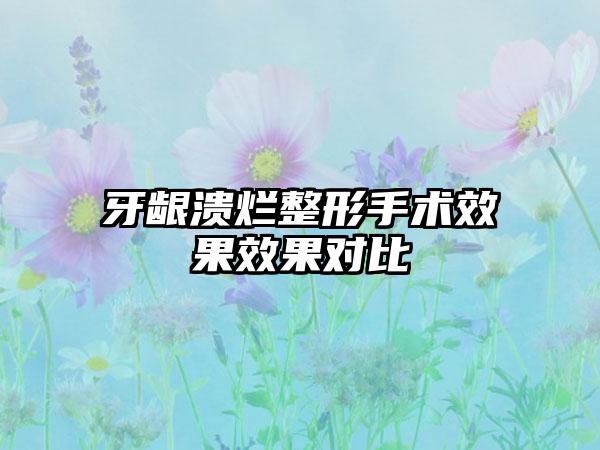 牙龈溃烂整形手术效果效果对比