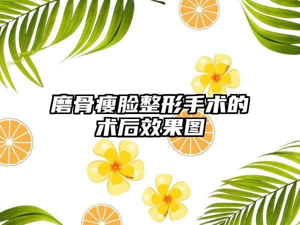 磨骨瘦脸整形手术的术后效果图